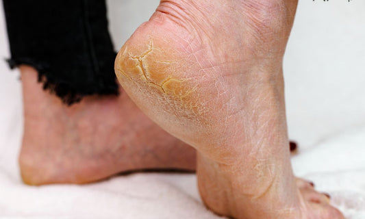 Safe for Diabetics & Sensitive Skin: Why Pheet Crack Heel Balm is the Best Balm