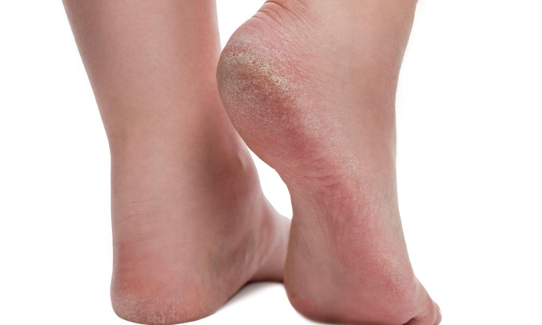 Understanding Cracked Heels and Dry Skin in Diabetes: Causes, Treatment, and Care