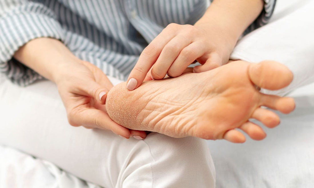 vitamin deficiency cracked heels