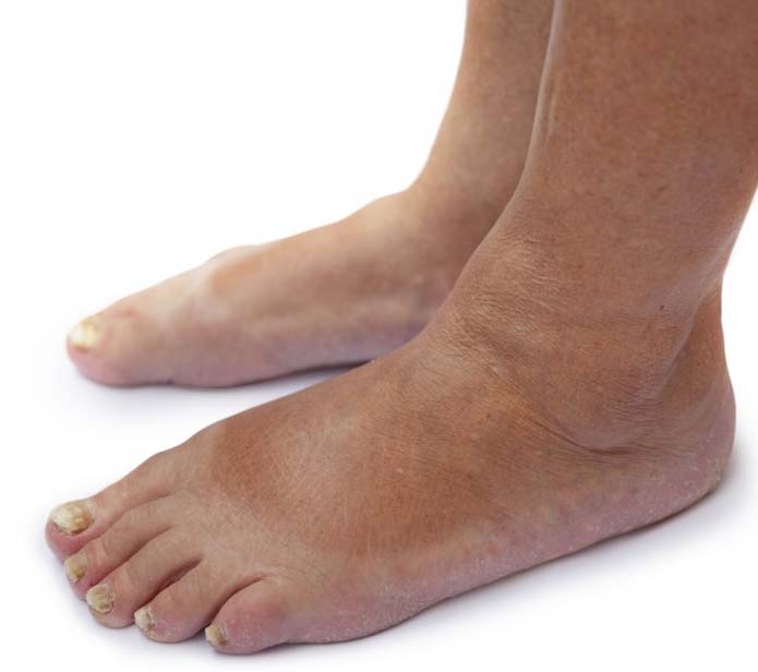 Swollen feet with yellow toenails showing fungal infection
