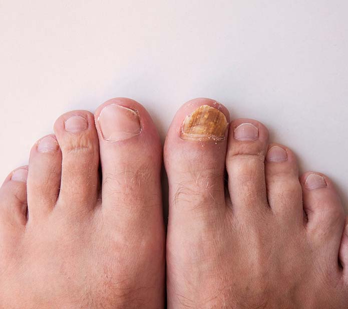 Foot with toenail discolouration showing fungal infection