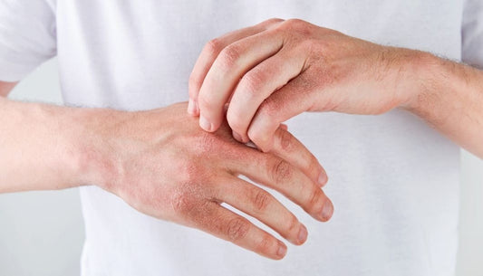 Cracked Hands Explained: Common Causes and Best Remedies