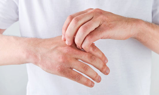 Cracked Hands Explained: Common Causes and Best Remedies