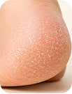 Day 1 - Roughness reduces | Foot care